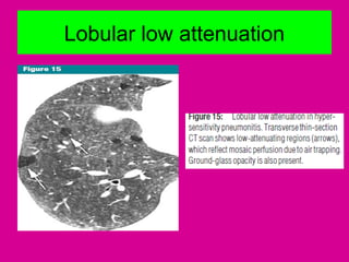 Lobular low attenuation
 