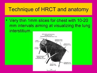 Technique of HRCT and anatomy
• Very thin 1mm slices for chest with 10-20
mm intervals aiming at visualizing the lung
interstitium.
 