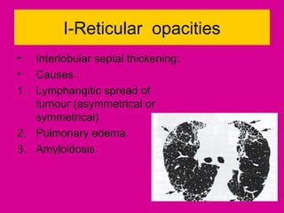 I-Reticular opacities
• Interlobular septal thickening:
• Causes :
1. Lymphangitic spread of
tumour (asymmetrical or
symmetrical)
2. Pulmonary edema.
3. Amyloidosis
 