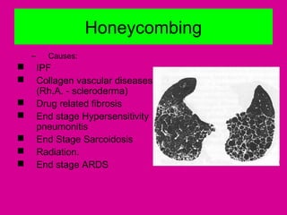 Honeycombing
– Causes:
 IPF
 Collagen vascular diseases
(Rh.A. - scleroderma)
 Drug related fibrosis
 End stage Hypersensitivity
pneumonitis
 End Stage Sarcoidosis
 Radiation.
 End stage ARDS
 