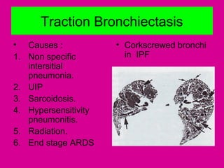 Traction Bronchiectasis
• Causes :
1. Non specific
intersitial
pneumonia.
2. UIP
3. Sarcoidosis.
4. Hypersensitivity
pneumonitis.
5. Radiation.
6. End stage ARDS
• Corkscrewed bronchi
in IPF
 