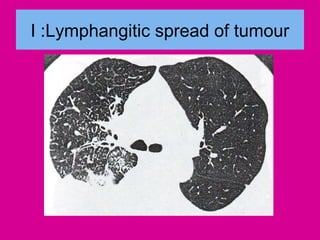 I :Lymphangitic spread of tumour
 