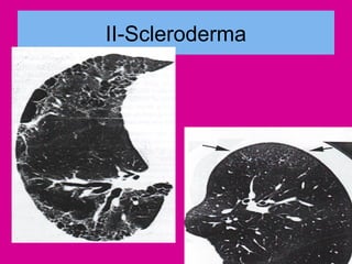 II-Scleroderma
 