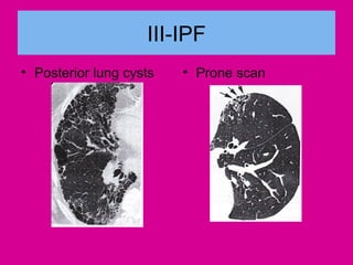 III-IPF
• Posterior lung cysts • Prone scan
 