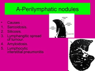 A-Perilymphatic nodules
• Causes :
1. Sarcoidosis.
2. Silicosis.
3. Lymphangitic spread
of tumour.
4. Amyloidosis.
5. Lymphocytic
interstitial pneumonitis
 