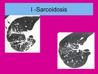 I -Sarcoidosis
 