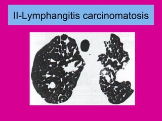 II-Lymphangitis carcinomatosis
 