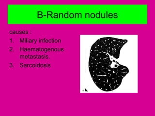 B-Random nodules
causes :
1. Miliary infection
2. Haematogenous
metastasis.
3. Sarcoidosis
 