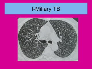 I-Miliary TB
 