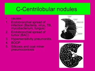 C-Centrilobular nodules
• causes :
1. Endobronchial spread of
infection (Bacteria, virus, TB,
mycobacterium, fungus)
2. Endobronchial spread of
tumor (BAC)
3. Hypersensitivity pneumonitis.
4. BOOP
5. Silicosis and coal miner
pneumoconiosis
 