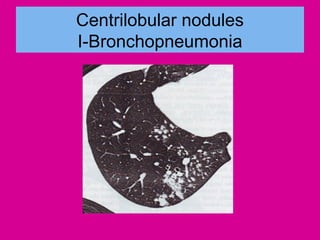 Centrilobular nodules
I-Bronchopneumonia
 