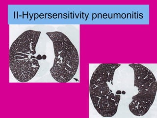 II-Hypersensitivity pneumonitis
 