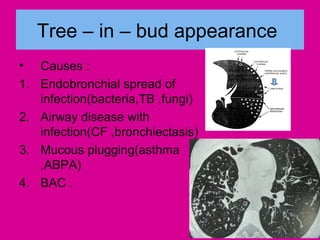 Tree – in – bud appearance
• Causes :
1. Endobronchial spread of
infection(bacteria,TB ,fungi)
2. Airway disease with
infection(CF ,bronchiectasis)
3. Mucous plugging(asthma
,ABPA)
4. BAC .
 