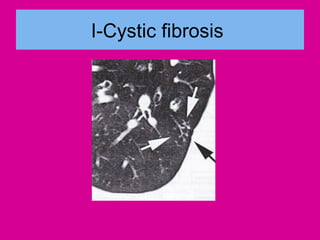 I-Cystic fibrosis
 