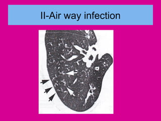 II-Air way infection
 