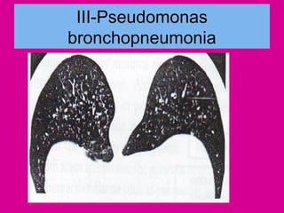 III-Pseudomonas
bronchopneumonia
 