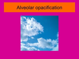 Alveolar opacification
 