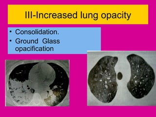 III-Increased lung opacity
• Consolidation.
• Ground Glass
opacification
 