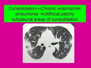 Consolidation-I-Chronic eosinophilic
pneumonia: multifocal,patchy
subpleural areas of consolidation
 