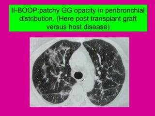 II-BOOP:patchy GG opacity in peribronchial
distribution. (Here post transplant graft
versus host disease)
 