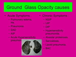 Ground Glass Opacity causes
• Acute Symptoms :
– Pulmonary edema,
He.
– Pneumonia.
– DAD
– AIP
– Acute Hypersensitivity
pneumonitis.
• Chronic Symptoms :
– NSIP
– UIP
– DIP
– Hypersensitivity
pneumonitis.
– Alveolar proteinosis.
– Sarcoidosis.
– Lipoid pneumonia.
– BAC
 