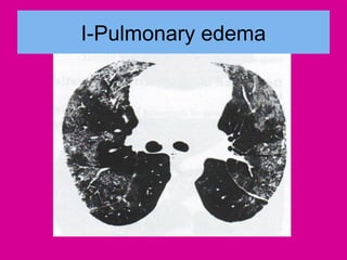 I-Pulmonary edema
 