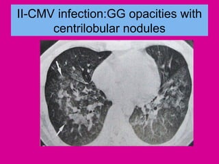 II-CMV infection:GG opacities with
centrilobular nodules
 
