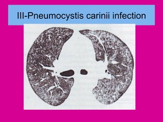 III-Pneumocystis carinii infection
 