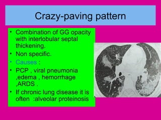 Crazy-paving pattern
• Combination of GG opacity
with interlobular septal
thickening.
• Non specific.
• Causes :
• PCP , viral pneumonia
,edema , hemorrhage
,ARDS .
• If chronic lung disease it is
often :alveolar proteinosis
 
