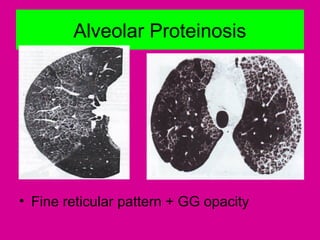 Alveolar Proteinosis
• Fine reticular pattern + GG opacity
 