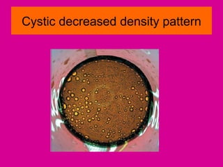 Cystic decreased density pattern
 