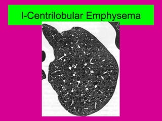 I-Centrilobular Emphysema
 
