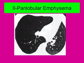 II-Panlobular Emphysema
 