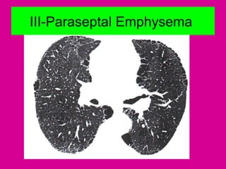 III-Paraseptal Emphysema
 