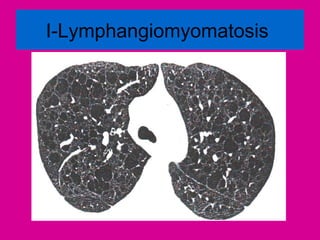 I-Lymphangiomyomatosis
 