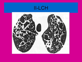 II-LCH
 
