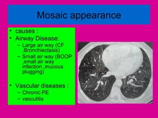 Mosaic appearance
• causes :
• Airway Disease:
– Large air way (CF
,Bronchiectasis)
– Small air way (BOOP
,small air way
infection ,mucous
plugging)
• Vascular diseases :
– Chronic PE
– vasculitis
 