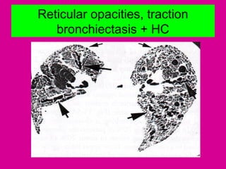 Reticular opacities, traction
bronchiectasis + HC
 
