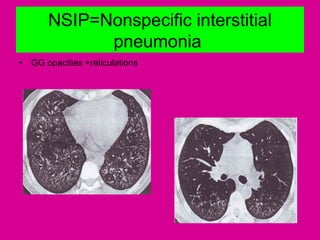 NSIP=Nonspecific interstitial
pneumonia
• GG opacities +reticulations
 