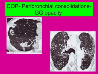 COP- Peribronchial consolidations-
GG opacity
 