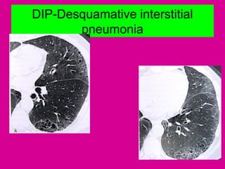 DIP-Desquamative interstitial
pneumonia
 