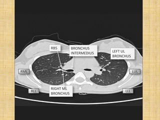 RB5        BRONCHUS
                       INTERMEDIUS   LEFT UL
                                     BRONCHUS


RML                                             LUL



            RIGHT ML
      RLL                                 LLL
            BRONCHUS
 