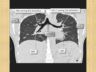 RB1 joining RUL bronchus       LB1,2 joining LUL bronchus



RC2

                                                              LC2


                                 CARINA




                    RB8                      LB8
 