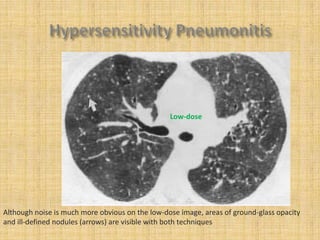 Low-dose




Although noise is much more obvious on the low-dose image, areas of ground-glass opacity
and ill-defined nodules (arrows) are visible with both techniques
 