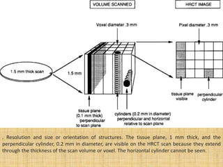 . Resolution and size or orientation of structures. The tissue plane, 1 mm thick, and the
perpendicular cylinder, 0.2 mm in diameter, are visible on the HRCT scan because they extend
through the thickness of the scan volume or voxel. The horizontal cylinder cannot be seen.
 