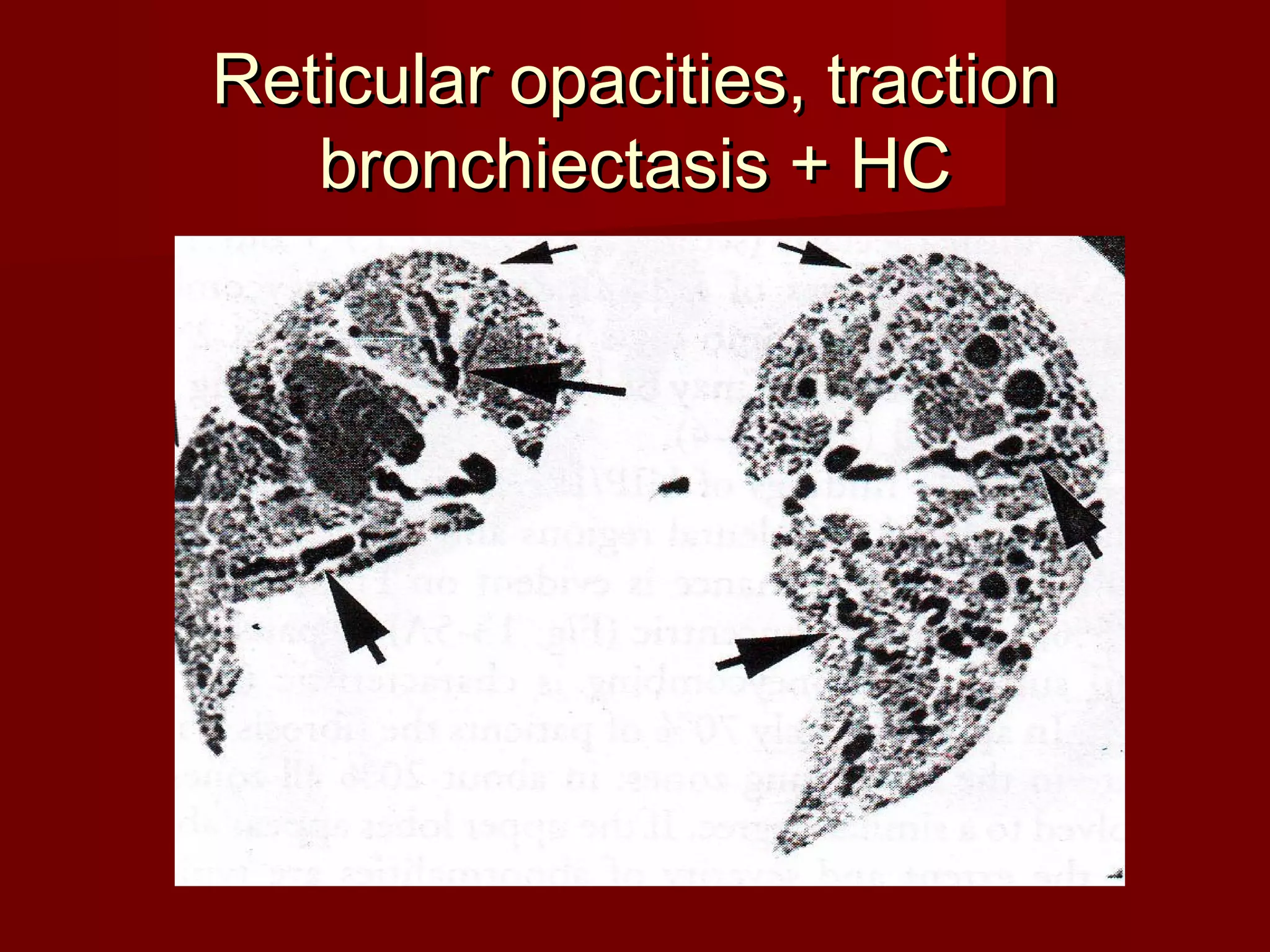 Hrct in diagnosis of diffuse lung diseases | PPT