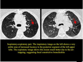 HRCT TECHNIQUE AND INTERPRETATION | PDF