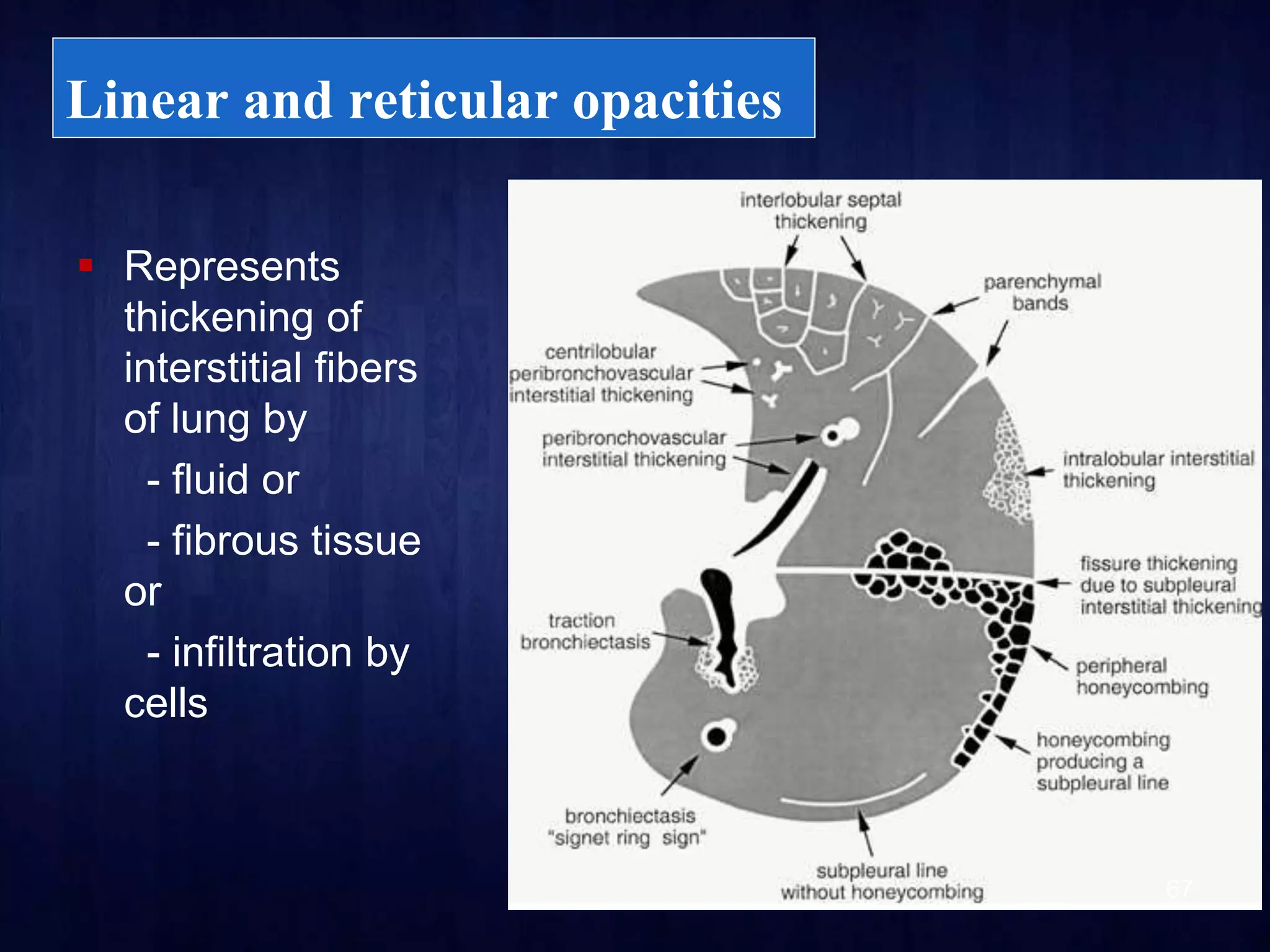 HRCT Chest - By Dr. Tinku Joseph | PPTX