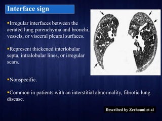 HRCT Chest - By Dr. Tinku Joseph | PPTX
