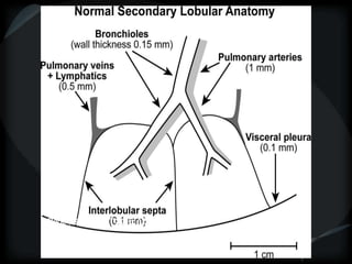 Raoof, S. , CHEST 2006; 129:805
 